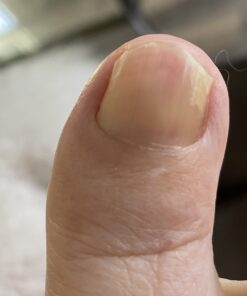 emuaid EMUAIDMAX Ointment 2oz - Eczema Cream. Maximum Strength Treatment. Use Max Strength for Athletes Foot, Psoriasis, Jock Itch, Anti Itch, Rash and Skin Yeast Infection. Standard Packaging 43 A1ik7pk hkL