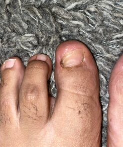 Toenail Renewal Solution Extra Strength Care for Toe Nail & Fingernails - Nail Repair Solution for Thick, broken, Discolored Nails - Renews Damaged Cracked Ingrown Toenail - Tea Tree Oil for Healthier and Extra Strength Nails - Made In USA 0.50 Fl Oz 67 A1wNrVTvfXL