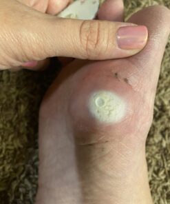 Compound W Maximum Strength One Step Plantar Wart Remover Foot Pads, 20 Count 20 Count (Pack of 1) 51 B12RR0YIfxS