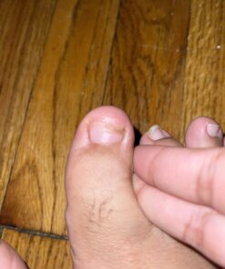 Toenail Renewal Solution Extra Strength Care for Toe Nail & Fingernails - Nail Repair Solution for Thick, broken, Discolored Nails - Renews Damaged Cracked Ingrown Toenail - Tea Tree Oil for Healthier and Extra Strength Nails - Made In USA 0.50 Fl Oz 68 B19uCnzu54S