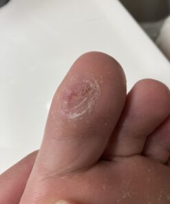 Compound W Maximum Strength One Step Plantar Wart Remover Foot Pads, 20 Count 20 Count (Pack of 1) 40 B1iwSYG55pS