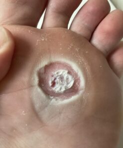 Compound W Maximum Strength One Step Plantar Wart Remover Foot Pads, 20 Count 20 Count (Pack of 1) 41 B1n7p6LuugS