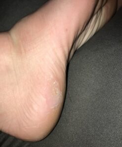 Compound W Maximum Strength One Step Plantar Wart Remover Foot Pads, 20 Count 20 Count (Pack of 1) 58 B1s7ONVpnKS