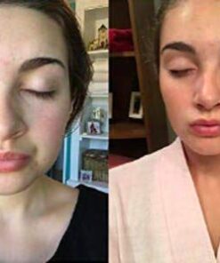 Natural Acne Cleanser - Gentle Face Wash To Clear and Control Acne Prone Skin - Tea Tree Oil, Aloe Vera & Gentle Essential Oils For A Refreshing Deep Clean - For Teens and Adults by Keeva Organics 20 41 4zAYGW1L 1