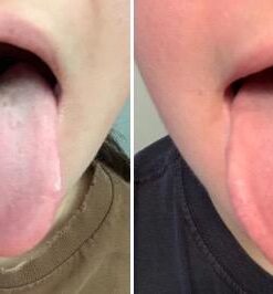 HealthAndYoga(TM) SteloSwipe Tongue Cleaner Scraper - Hygienic Seal-Pack - Surgical Grade Stainless Steel, Non-Synthetic Grip - Sterilizable Metal Tongue Scraper for Adults (1 Pack with Storage Bag) Surgical Steel - 1 Pack 59 41G1OyFKmRL