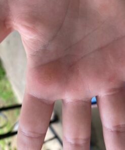 Compound W Nitrofreeze | Wart Removal | 1 Pen & 5 Replaceable Tips 57 41b4EFyUDcL