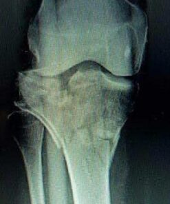 PROFOOT Orthotic Insoles for Plantar Fasciitis & Heel Pain, Women's 6-10, Gel Heel Shock Absorbing Insoles to Help Reduce Pain & Stress, Foot Care Arch Support Inserts for Shoes 1 Pair 45 41sWdvNmgXL