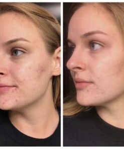 Natural Acne Cleanser - Gentle Face Wash To Clear and Control Acne Prone Skin - Tea Tree Oil, Aloe Vera & Gentle Essential Oils For A Refreshing Deep Clean - For Teens and Adults by Keeva Organics 19 41xetdViZEL 1