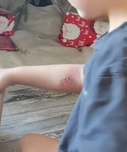 TEA TREE OIL BALM -100% All Natural | Great Cream for Soothing Irritations like Eczema, Psoriasis, Rashes, Insect Bites, Folliculitis, Acne, Itches, Dry Chapped Heels, Cuticles, Saddle Sores and more! 54 41xt8ulQsoL