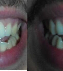 Crest 3D Whitestrips, Glamorous White, Teeth Whitening Strip Kit, 28 Strips (14 Count Pack) Flavorless 28 Count (Pack of 1) 38 41yC 4GU1LL