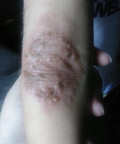 SkinSmart Antimicrobial Eczema Therapy with Hypochlorous Acid, Removes Bacteria so Skin Can Heal, for Adults, Kids and Seniors, 8 Ounce Clear Spray 8 Fl Oz (Pack of 1) 38 513vBtySL