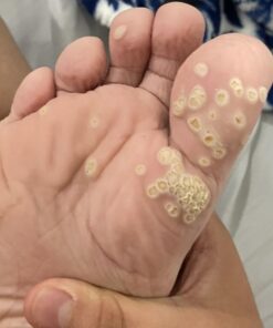 Compound W Maximum Strength Fast Acting Gel Wart Remover, 0.25 oz, 2 Pack unflavored 0.5 Ounce (Pack of 1) 44 515Dyh7cVwL