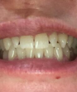 Auraglow 35% Teeth Whitening Gel Syringe Refill Pack, 35% Carbamide Peroxide, 30 Whitening Treatments, (3) 5mL Whitening Gel Syringes, Sensitive Teeth Whitening 36 5172YV FMML