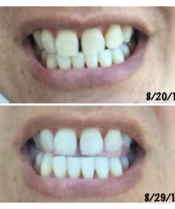 Crest 3D Whitestrips, Glamorous White, Teeth Whitening Strip Kit, 28 Strips (14 Count Pack) Flavorless 28 Count (Pack of 1) 36 5180zMGJ1L