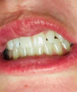 Auraglow 35% Teeth Whitening Gel Syringe Refill Pack, 35% Carbamide Peroxide, 30 Whitening Treatments, (3) 5mL Whitening Gel Syringes, Sensitive Teeth Whitening 37 51DZ47mq6L