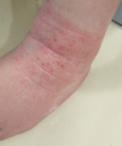 SkinSmart Antimicrobial Eczema Therapy with Hypochlorous Acid, Removes Bacteria so Skin Can Heal, for Adults, Kids and Seniors, 8 Ounce Clear Spray 8 Fl Oz (Pack of 1) 41 51EWowmrjmL