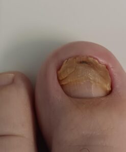 Extra Strength-100% All Natural Fungus Nail Solution for Toenail & Fingernails: Renew Thick, Broken & Discolored Nails Made by Purely Northwest -1fl.oz Tea Tree Oil 1 Fl Oz (Pack of 1) 28 51Hv3ryfoNL