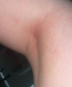 SkinSmart Antimicrobial Eczema Therapy with Hypochlorous Acid, Removes Bacteria so Skin Can Heal, for Adults, Kids and Seniors, 8 Ounce Clear Spray 8 Fl Oz (Pack of 1) 36 51OoVgqgBvL