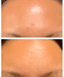 Benzoil - 3% Benzoyl Peroxide & 2% Tea Tree Oil Rapid Acne & Spot Treatment Serum - 70% Organic, Preservative-Free, Normal & Cystic Acne - 2 oz 18 51nirFmi97L 1