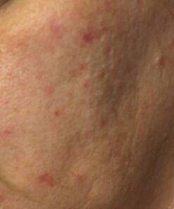 YEOUTH Glycolic Acid Peel for Face Professional 30% Gel with Retinol & Green Tea, Chemical Peel for Face at Home for Wrinkles, Dark Spots & Acne, Skin Care Chemical Exfoliant, Glycolic Acid Serum Glycolic 30% Peel 1oz 31 51o3dUQgMqL 1