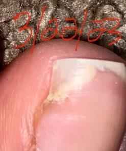 Toenail Fungus Treatment Extra Strength with 25% Undecylenic Acid - Fungal Nail Treatment for Toe Nail & Fingernails - Antifungal Nail Repair Solution for Discoloured & Ingrown Nails – Made in USA 0.5 Fl Oz (Pack of 1) 55 51pyPZ8GZAL 3