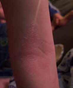 SkinSmart Antimicrobial Eczema Therapy with Hypochlorous Acid, Removes Bacteria so Skin Can Heal, for Adults, Kids and Seniors, 8 Ounce Clear Spray 8 Fl Oz (Pack of 1) 39 51sjMv8HdGL