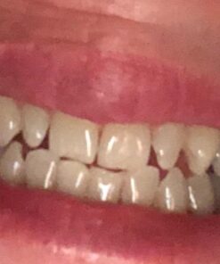 Auraglow 35% Teeth Whitening Gel Syringe Refill Pack, 35% Carbamide Peroxide, 30 Whitening Treatments, (3) 5mL Whitening Gel Syringes, Sensitive Teeth Whitening 38 51zsgj0bvDL