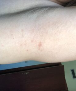 SkinSmart Antimicrobial Eczema Therapy with Hypochlorous Acid, Removes Bacteria so Skin Can Heal, for Adults, Kids and Seniors, 8 Ounce Clear Spray 8 Fl Oz (Pack of 1) 49 61 3XbPExmL