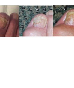 Fungi Nail Anti-Fungal Ointment, Kills Fungus That Can Lead to Nail & Athlete’s Foot with Tolnaftate & Clinically Proven to Cure Infections, Natural Color, 0.7 Fl Oz 36 61 ydFZGdGL