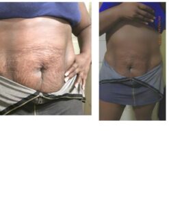 Ultimate Body Applicator Lipo Wrap Works For Body Firming Cellulite Reducing Toning Contouring 4 Wraps 4 Count (Pack of 1) 39 6100CddSPiL