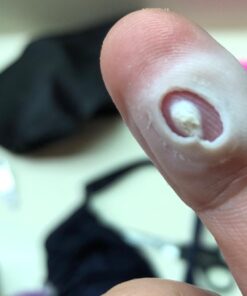 Compound W Nitrofreeze | Wart Removal | 1 Pen & 5 Replaceable Tips 42 6107PsiuCpL