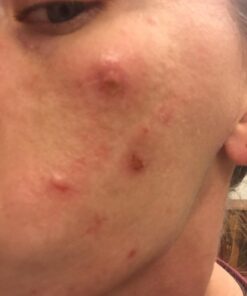 Acnetame Acne Pills- Vitamin Supplements for Acne Treatment- Natural Clear Skin from Hormonal Cystic Pimples- Oily Skin Vitamins Pill for Women, Teen, Men, & Adults 60 Tablets 60 Count (Pack of 1) 50 610ng22ofNL 1