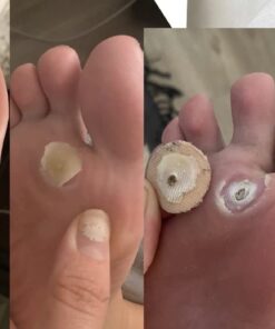 Compound W Maximum Strength Fast Acting Gel Wart Remover, 0.25 oz, 2 Pack unflavored 0.5 Ounce (Pack of 1) 45 6127uonN61L