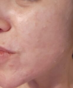 YEOUTH Glycolic Acid Peel for Face Professional 30% Gel with Retinol & Green Tea, Chemical Peel for Face at Home for Wrinkles, Dark Spots & Acne, Skin Care Chemical Exfoliant, Glycolic Acid Serum Glycolic 30% Peel 1oz 41 615Z9fNFUoL