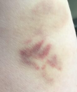 Cammile Q Organic Tamanu Oil - Natural Psoriasis Treatment - Great For Eczema, Acne & Scars - Cold Pressed 47 615bToX4PSL