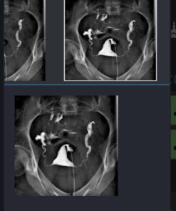 Doctor's Best High Potency Serrapeptase, Non-GMO, Gluten Free, Vegan, Supports Healthy Sinuses, 120,000 SPU, 90 Count 90 Count (Pack of 1) 37 618CsVggTKL