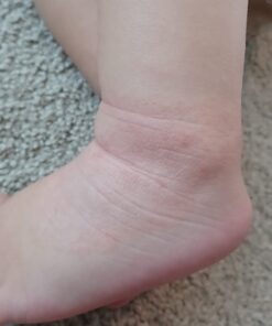 SkinSmart Antimicrobial Eczema Therapy with Hypochlorous Acid, Removes Bacteria so Skin Can Heal, for Adults, Kids and Seniors, 8 Ounce Clear Spray 8 Fl Oz (Pack of 1) 42 618fXW087WL