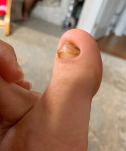 Toenail Fungus Treatment Extra Strength with 25% Undecylenic Acid - Fungal Nail Treatment for Toe Nail & Fingernails - Antifungal Nail Repair Solution for Discoloured & Ingrown Nails – Made in USA 0.5 Fl Oz (Pack of 1) 49 618h7L5X8kL 3