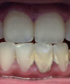 Dental Hygiene Kit - Calculus & Plaque Remover Dental Tool Set - Stainless Steel Tarter Scraper, Tooth Pick, and Mouth Mirror - Dentist Instrument Set for Teeth Cleaning (Blue) Blue 43 619wPDHp2LL