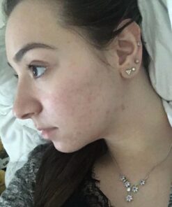 Organic Rosehip Oil – 100% Pure Unrefined Cold Pressed Rosehip Seed Oil - Best Moisturizer for Face, Hair - Great for Fine Lines, Wrinkles, Acne Scars, Sun Damage, Stretch Marks, Eczema, Psoriasis 4 Fl Oz (Pack of 1) 34 61A9nTj tuL