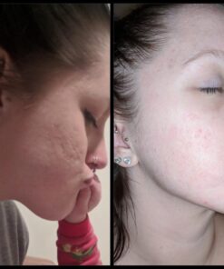 Organic Rosehip Oil – 100% Pure Unrefined Cold Pressed Rosehip Seed Oil - Best Moisturizer for Face, Hair - Great for Fine Lines, Wrinkles, Acne Scars, Sun Damage, Stretch Marks, Eczema, Psoriasis 4 Fl Oz (Pack of 1) 28 61BvlqJDfIL