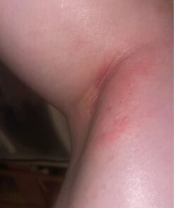 SkinSmart Antimicrobial Eczema Therapy with Hypochlorous Acid, Removes Bacteria so Skin Can Heal, for Adults, Kids and Seniors, 8 Ounce Clear Spray 8 Fl Oz (Pack of 1) 37 61CfGAM30tL