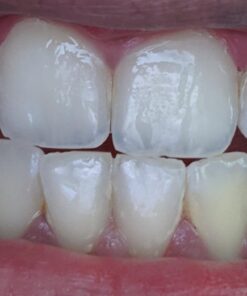 Dental Hygiene Kit - Calculus & Plaque Remover Dental Tool Set - Stainless Steel Tarter Scraper, Tooth Pick, and Mouth Mirror - Dentist Instrument Set for Teeth Cleaning (Blue) Blue 44 61JS1UeJacL