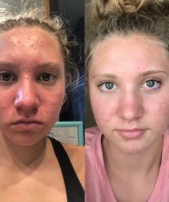 Acnetame Acne Pills- Vitamin Supplements for Acne Treatment- Natural Clear Skin from Hormonal Cystic Pimples- Oily Skin Vitamins Pill for Women, Teen, Men, & Adults 60 Tablets 60 Count (Pack of 1) 37 61K3o5nXLcL 1