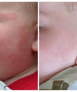 Eucerin Baby Eczema Relief Body Cream - Steroid & Fragrance Free for 3+ Months of Age - 5 oz. Tube 43 61K8bhQPM L