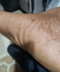 Dr. Nordyke's Wound Honey New Zealand Manuka Honey for Infections,Burns,Cuts and Scars (80g) 2.8 Ounce (Pack of 1) 19 61L1cuh9KTL