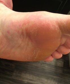 Microplane Colossal Foot File Scraper - The Original Stainless Steel Foot Rasp, Dead Skin/Callus Remover for Feet, Gentle Foot Scrubber, Pedicure Tools for Salon-Quality Foot Care, Black 51 61N0kH5Z6uL