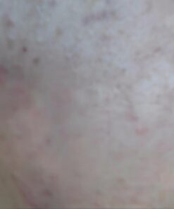 ClearZine Acne Pills for Teens & Adults (2 Bottles) | Clear Skin Supplement, Vitamins for Hormonal & Cystic Acne, 90 Caps Each 37 61NgqfJX5vL