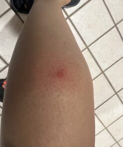 TEA TREE OIL BALM -100% All Natural | Great Cream for Soothing Irritations like Eczema, Psoriasis, Rashes, Insect Bites, Folliculitis, Acne, Itches, Dry Chapped Heels, Cuticles, Saddle Sores and more! 48 61P5TIe7mPL