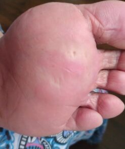 Emjoi Micro-Pedi 3D POWER Callus Remover with Xtreme Coarse Soft & Flexible Roller (Most Powerful & Corded) Blue 1 Count (Pack of 1) 21 61PNGAPRR4L